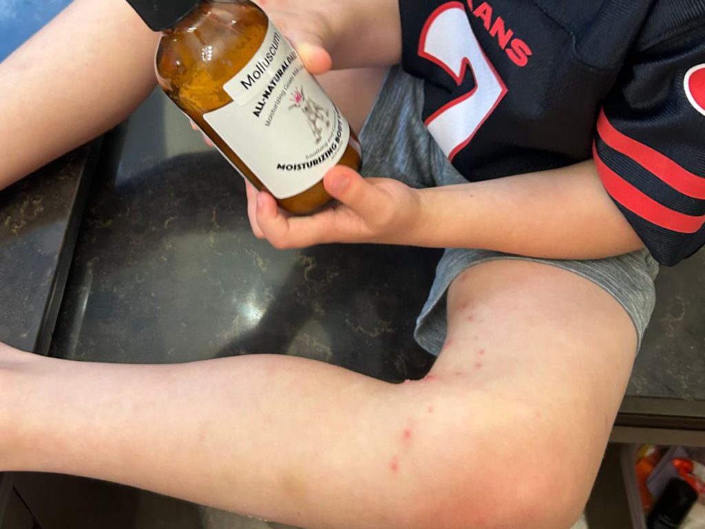 molluscum contagiosum in kids